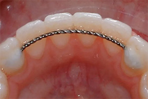 Retainer Instructions - LA Dental Braces | Los Angeles San Diego CA